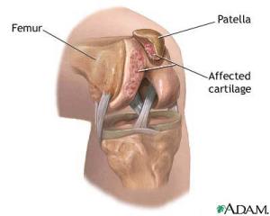 Chondromalacia of the Patella Knee Cap